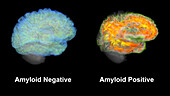 Healthy brain and brain with amyloid plaques, MRI scans