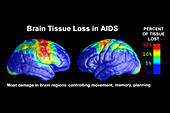 Brain tissue loss in AIDS, MRI scans