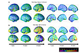 Brain development before and after paediatric bipolar disorder, MRI scans