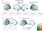Brain development before and after paediatric bipolar disorder, MRI scans