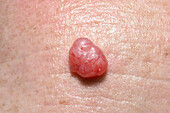 Basal cell carcinoma