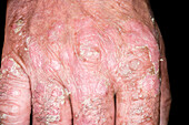 Psoriasis flare-up during treatment