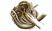Retained placenta, 19th century illustration