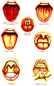 Oral diseases, illustration
