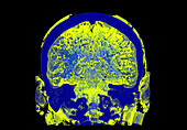 Ischaemic stroke, CT scan