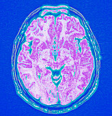 Human brain, MRI scan