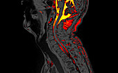 Slipped disc, MRI scan