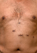 Abdominal surgery wounds