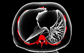 Tension pneumothorax, CT scan