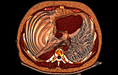 Tension pneumothorax, CT scan
