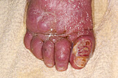 Infected ulcer on a woman's big toe