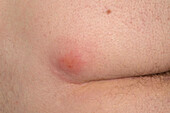 Pilonidal cyst on a man's buttocks