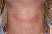 Eczema on a woman's neck