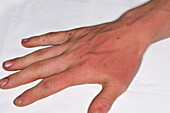 Erythema on a man's hand
