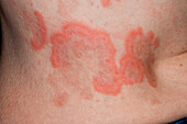 Hives on a woman's skin