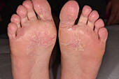 Cracked skin from eczema on the sole of a girl's foot