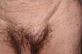 Inguinal hernia on a man's groin