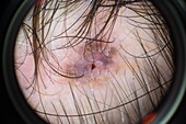 Seborrheic keratosis on a woman's scalp