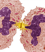 Dividing cancer cell, TEM