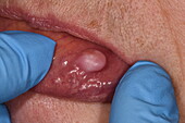Fibroepithelial polyp on a woman's lip