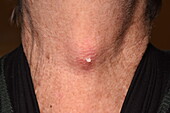 Sebaceous cyst on woman's neck