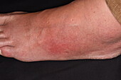 Gout on a man's foot