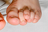 Syndactyly on a boy's foot