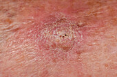 Squamous cell carcinoma on a woman's leg