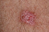 Basal cell carcinoma on a man's arm