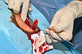 Malignant melanoma excision