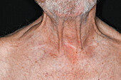 Lump above man's clavicle due to lymphoma