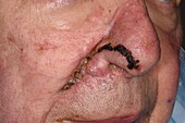 Healing wound with sutures on a man's face