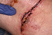 Wound on a woman's knee after fall