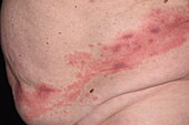 Shingles rash on a man's trunk