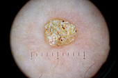 Filiform wart on a woman's knee