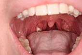 Tonsillitis in a girl's throat