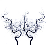 Cerebral arteries, angiogram