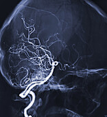 Cerebral arteries, angiogram