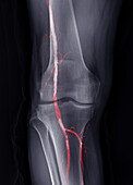 Knee arteries, X-ray and CT scan