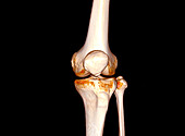 Knee joint, CT scan