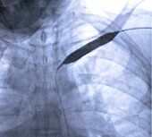 Treatment for blocked arteries, angiogram