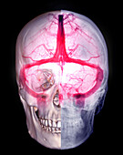 Cerebral veins, MRV scan