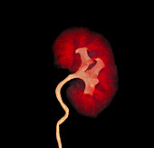 Kidney, CT scan