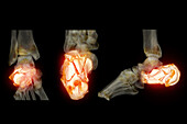 Fractured heel, CT scans