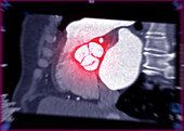 Healthy aortic valve, CT scan