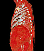 Pulmonary artery, CT scan