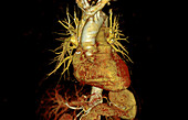 Human heart, CT scan