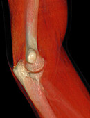 Fractured elbow, CT scan