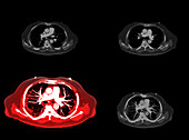 Pulmonary artery, CT scans