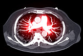 Pulmonary artery, CT scan